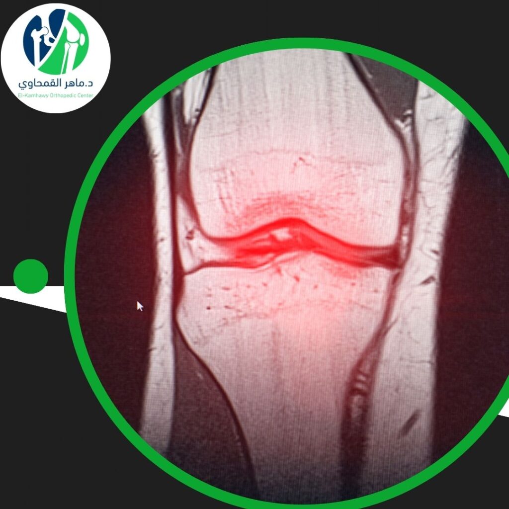 علاج الغضروف في إسكندرية