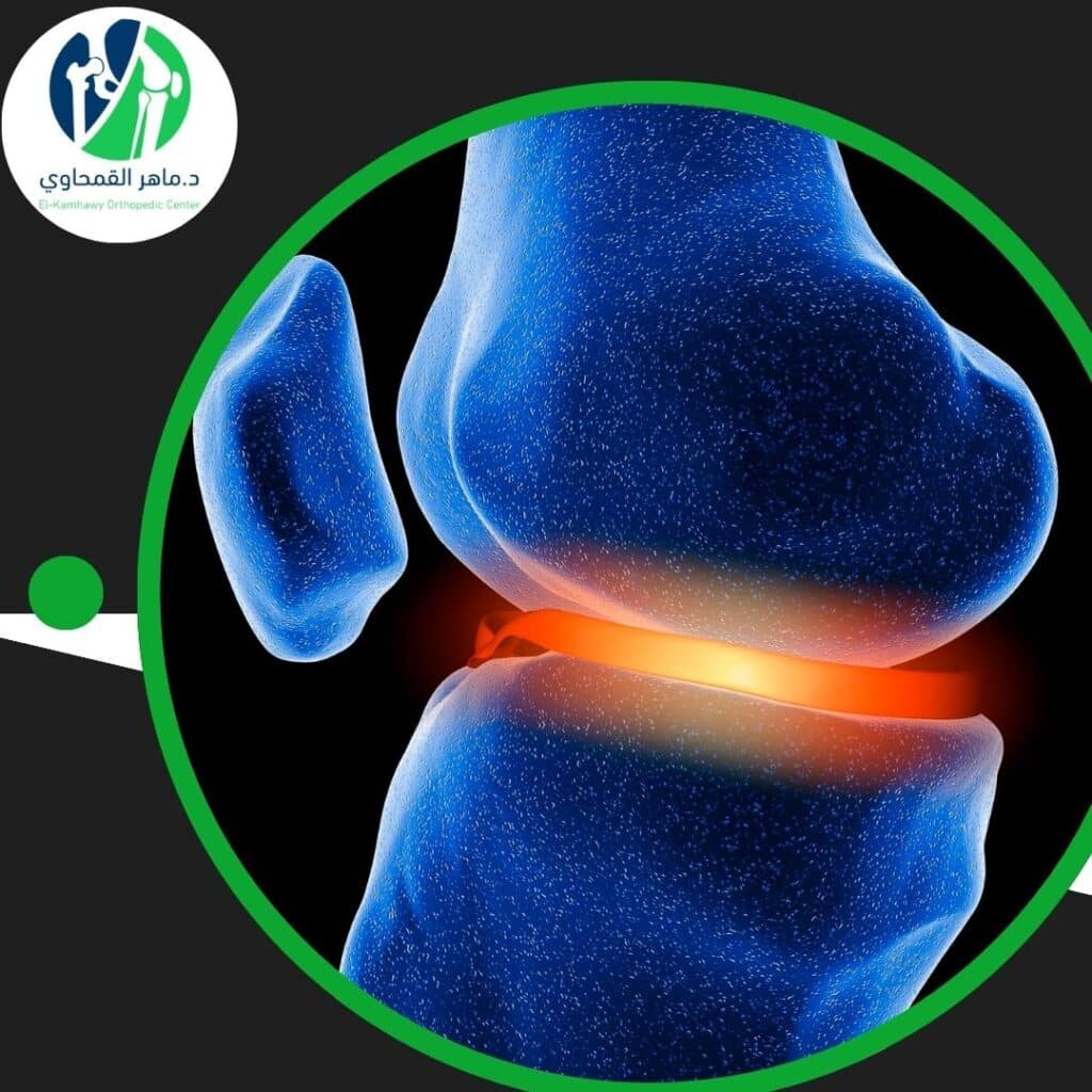 دكتور جراحات الركبة الغضروف الهلالي 4 دكتور جراحات الركبة الغضروف الهلالي (2)