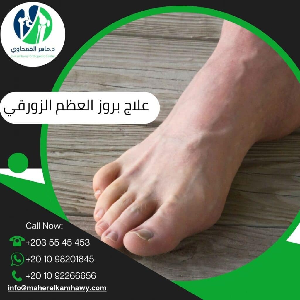 علاج بروز العظم الزورقي في القدم