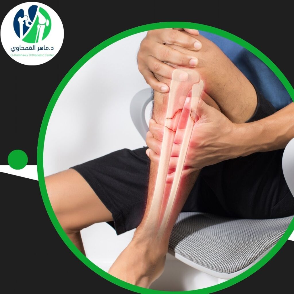 أخطاء شائعة تؤخر شفاء الكسور