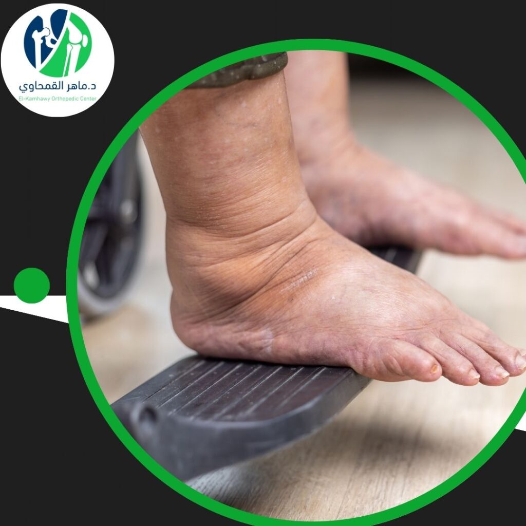 انتفاخ القدم بعد إجراء عملية جراحية في الكاحل (1)