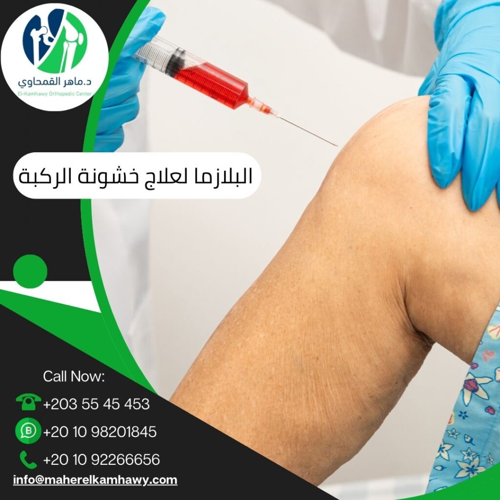 حقن البلازما لعلاج خشونة الركبة 5 حقن البلازما لعلاج خشونة الركبة