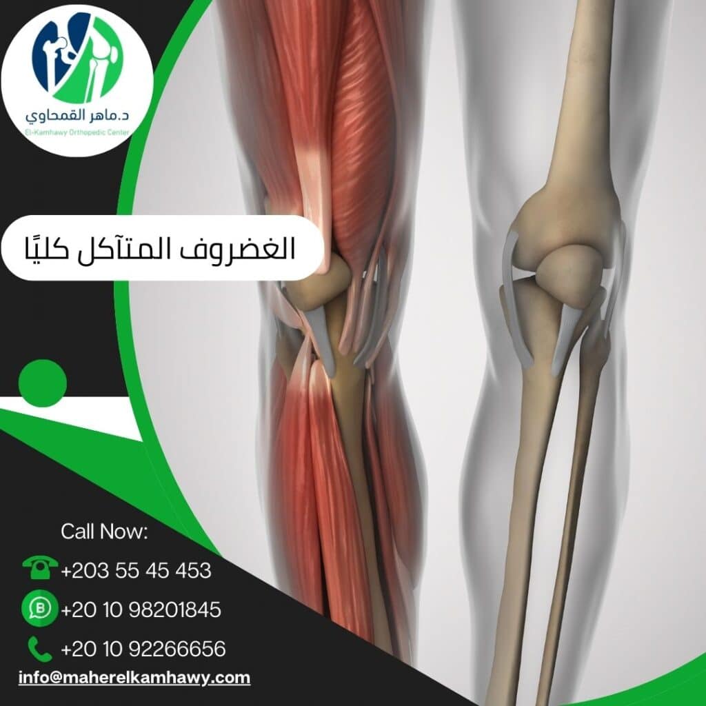 علاج الغضروف المتآكل كليًا